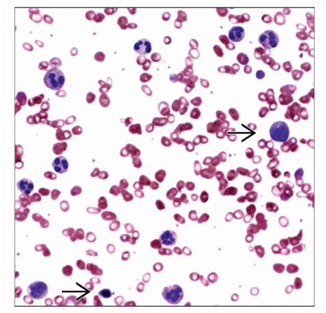 Primary Myelofibrosis Pictures