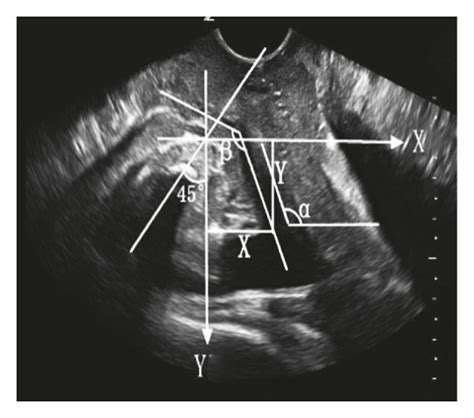 Pelvic Floor Transperineal Ultrasound Measurement Of Patients X The
