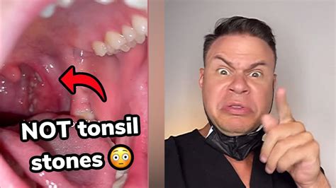 These May Look Like Tonsil Stones But They Are Way Worse Youtube
