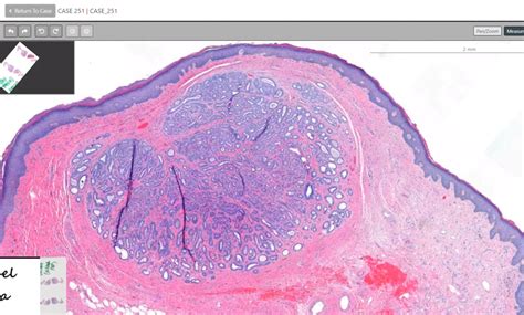 Identifying Sweat Gland Tumors Pathologywatch Digital Pathology