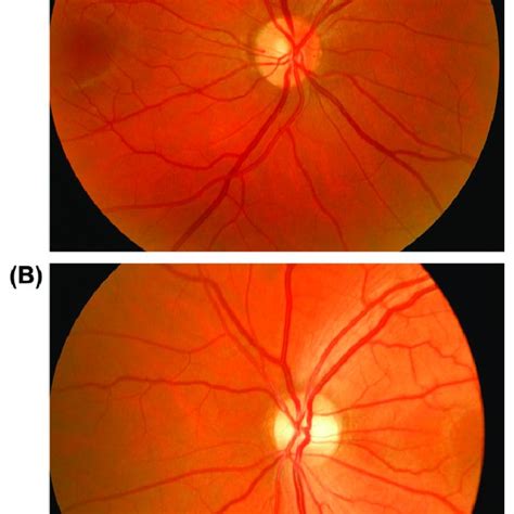 A B Fundoscopy Showing Band Atrophy Of The Left Eye And A Normal Optic