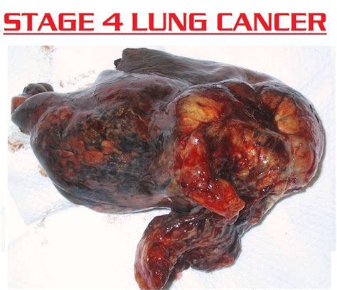 Discover what happens at this stage such as symptoms, prognosis, and treatment. about lung cancer 3000: stage 4 lung cancer