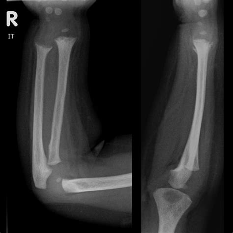 Fraying Splaying And Cupping Of The Distal Radial And Ulnar Metaphyses