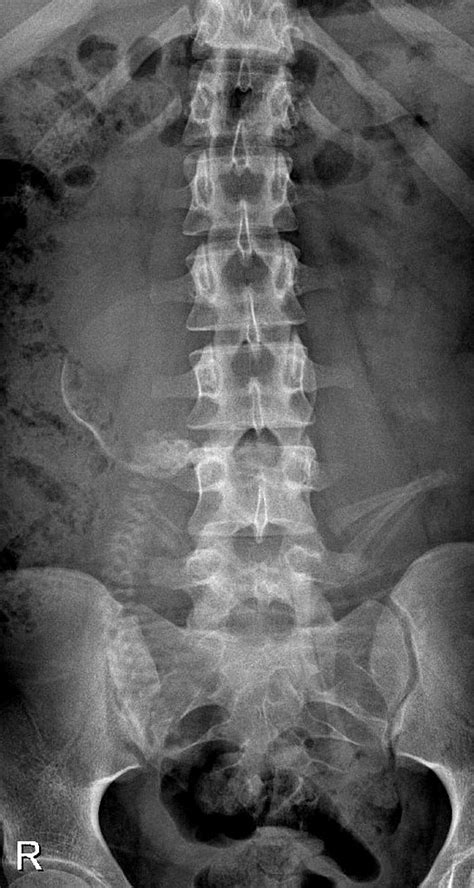 Pregnant X Ray Telegraph