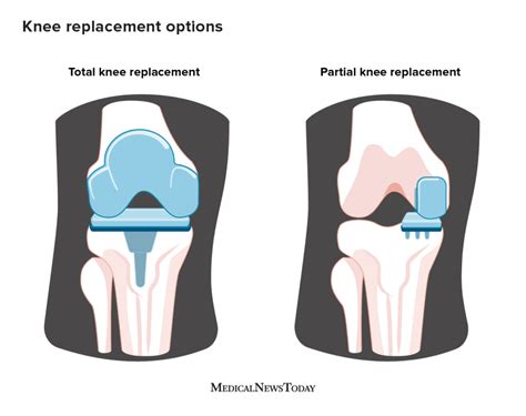 Types Of Knee Replacement