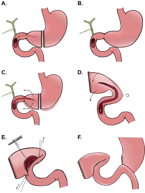 A Schematic Illustration Of Performing A Gastroduodeno Plasty To Cover
