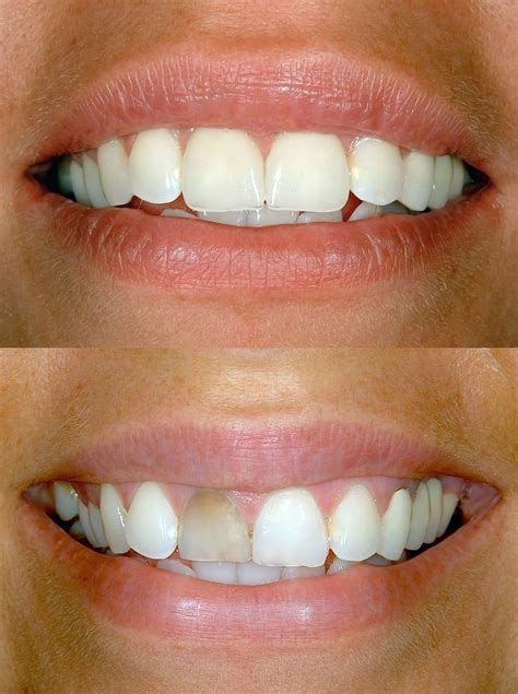 Tooth Bonding And Cosmetic Fixes Dentists In Burlington Nc