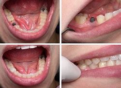Image result for single dental implant