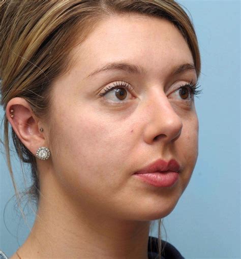 Filler For Nasolabial Folds In San Francisco Mabrie Facial Institute