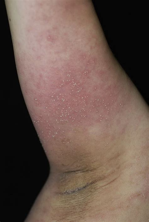 Multiple Diffuse Erythematous Maculopatches Studded With Several