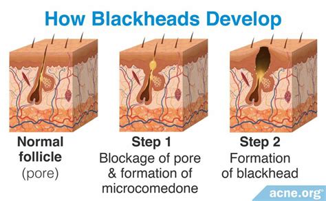 What Is A Blackhead