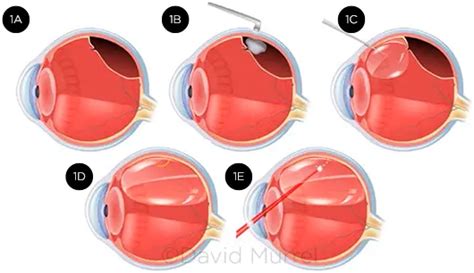 When And How To Use Pneumatic Retinopexy American Academy Of