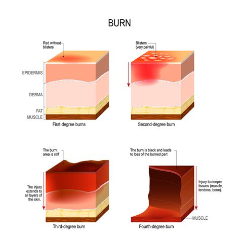 These burns are less painful due to the nerve endings being damaged. The Impact of Hyperglycemia in Burn Trauma - Monarch ...