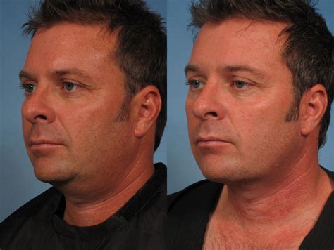 Male Faceneck Lift Before And After Pictures Case 163 Naples And Ft