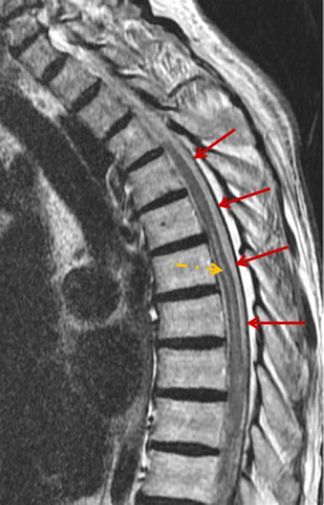Spinal Subdural Hematoma A Rare Case Of Spinal Subdural Hematoma