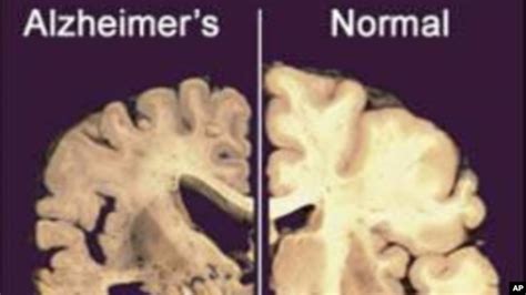 Antibody Therapy Clears Destructive Alzheimers Brain Plaques
