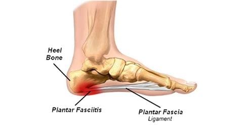 Chronic Plantar Fasciitis Movement Minded PhysioTherapy