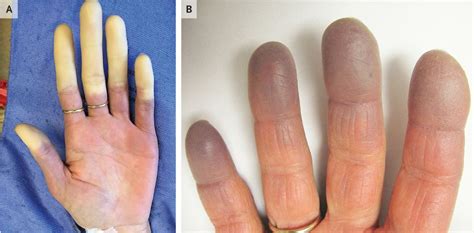 Scleroderma Burlington Vt University Of Vermont Medical Center