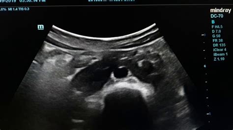 Horseshoe Kidneys Ultrasound Youtube