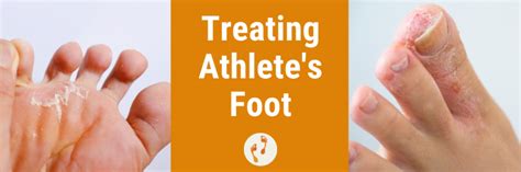 Treating Athletes Foot This Summer Masterton Podiatrist