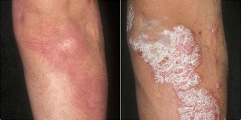 Psoriasis New Treatments Excellent Results