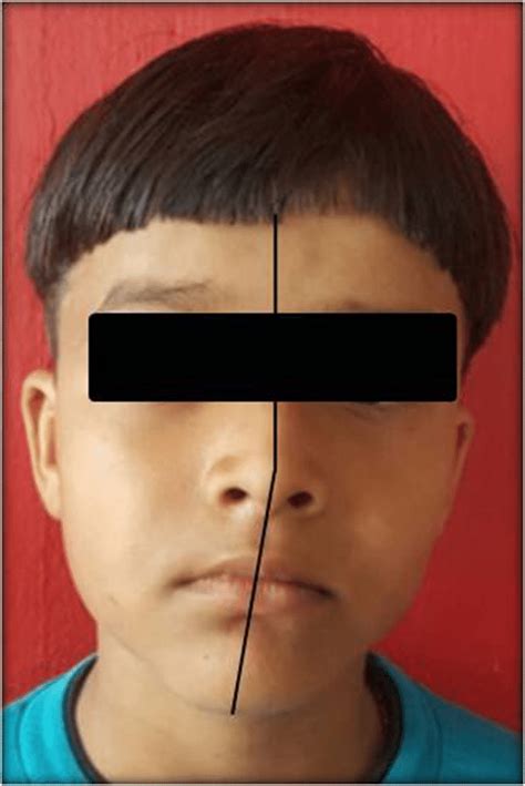 Extraoral Photograph Showing Facial Asymmetry Chin Deviated Towards