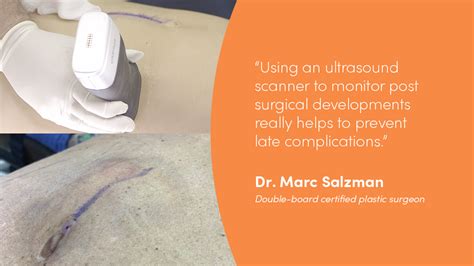 Using Handheld Ultrasound To Diagnose And Treat Abdominoplasty Seromas