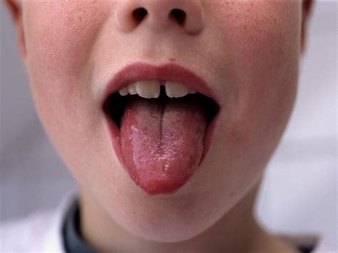 Scarlet Fever Doctors Warn Parents To Look Out For Symptoms Amid