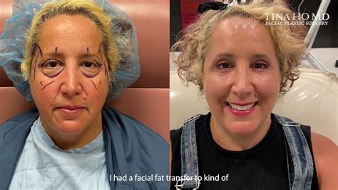 Brow Lift And Eyelid Surgery Patient Testimonial Youtube