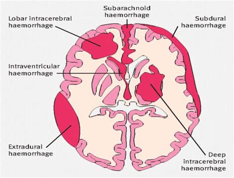 Different Types Of Brain Hemorrhage