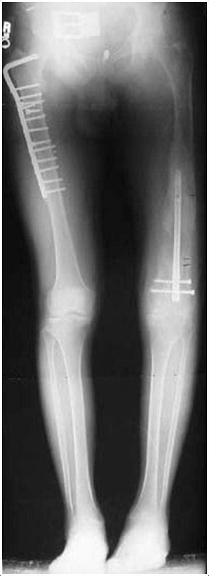 Leg Shortening After Femur Fracture