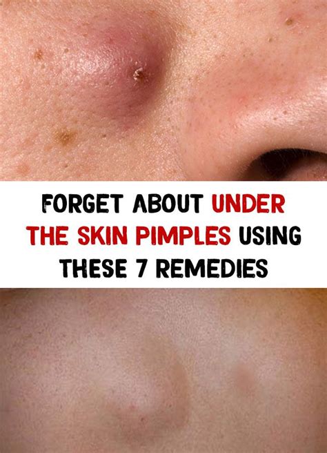 forget about under the skin pimples using these 7 remedies pimples pimples under the skin