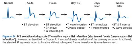 The four main changes all doctors and medical students should know inside out that occur in a stemi.there are different changes in posterior mi, nstemis and. Acute STEMI Management - Mnemonic based approach | Epomedicine