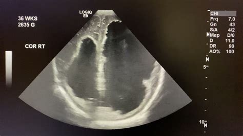 Ultrasound Cases Neurosonography Hydrocephalus Abnormal Neonatal