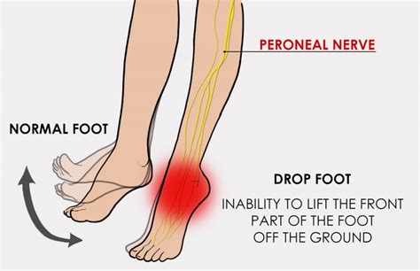 Foot Drop Cause Symptoms Treatment Exercise Mobile Physio