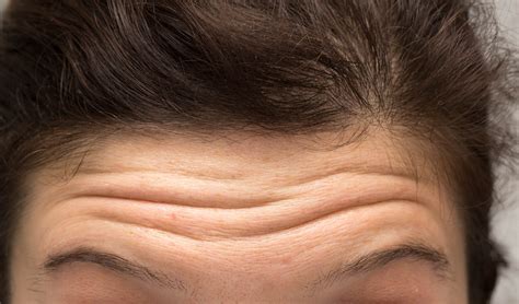 Natural Remedies To Get Rid Of Wrinkles On Forehead Health N