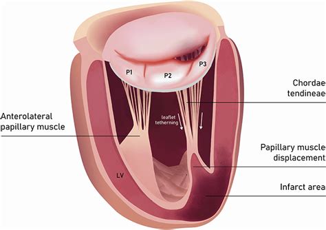 Frontiers Direct Percutaneous Mitral Annuloplasty In Patients With