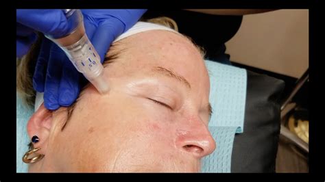 remove crow s feet with microneedling youtube