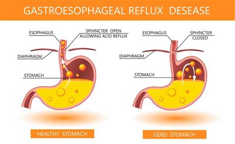 Identifying Silent Reflux Or Lpr Symptoms And Causes