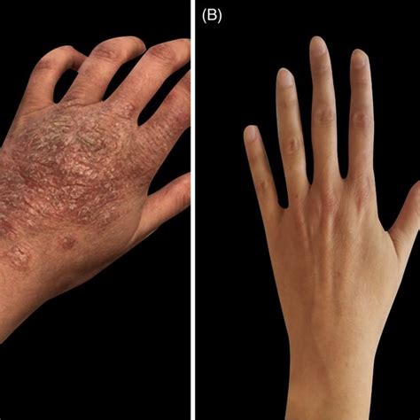 A Chronic Spontaneous Urticaria Affecting Patients Wrist Before