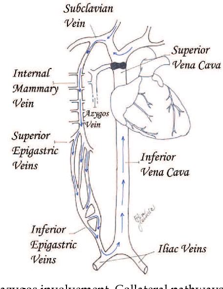 Figure 4 From 23 Superior Vena Cava Syndrome Semantic Scholar