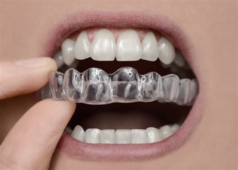 Clear Retainers What Are The Different Types