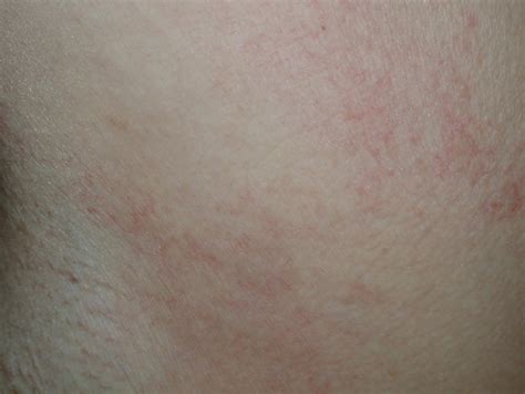 Different Xerosis And Eczema Linked To Egfri Treatment Oncologypro