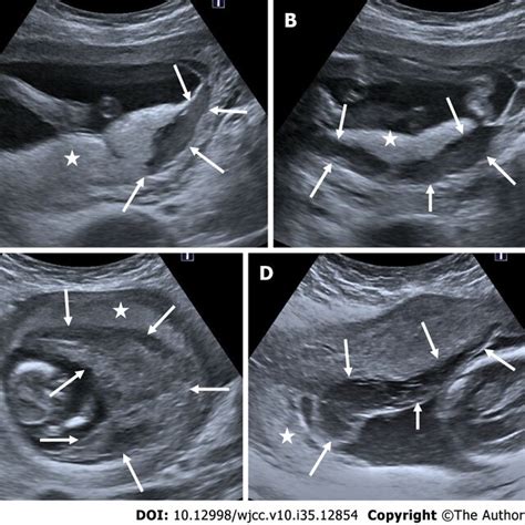 Chorioamniotic Separation A C In 3 Different Pregnant Women Between