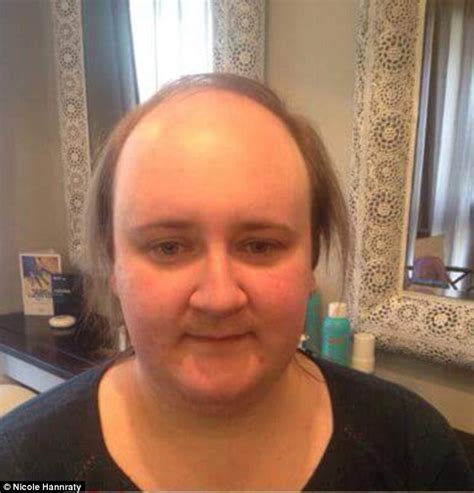 Woman Who Was Left Devastated After Going Bald At Just Says That