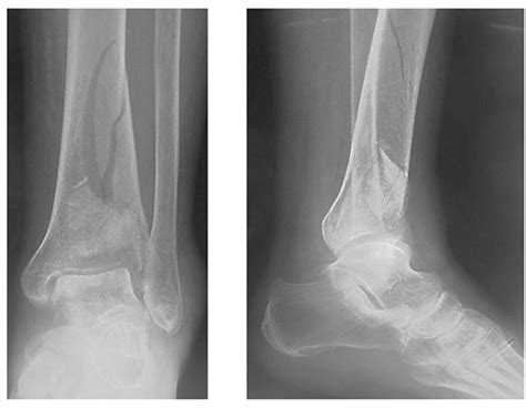 Advantages Of Ilizarov External Fixation In An Elderly Patient With
