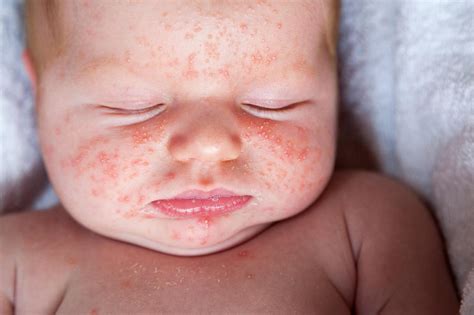 علاج الطفح الجلدي عند الأطفال الرضع مجلتك