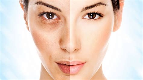 Wendel has a laser that targets a variety of skin problems at different layers of the skin. How to Get Perfect Complexion With Laser Skin Treatments ...