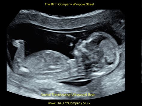 Nuchal Translucency Scan £215 11 14 Weeks Pregnancy Scan The Birth