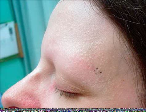 Numerous Skin Colored Papules On The Face And Neck—quiz Case